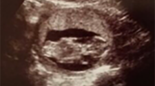Ultrasound